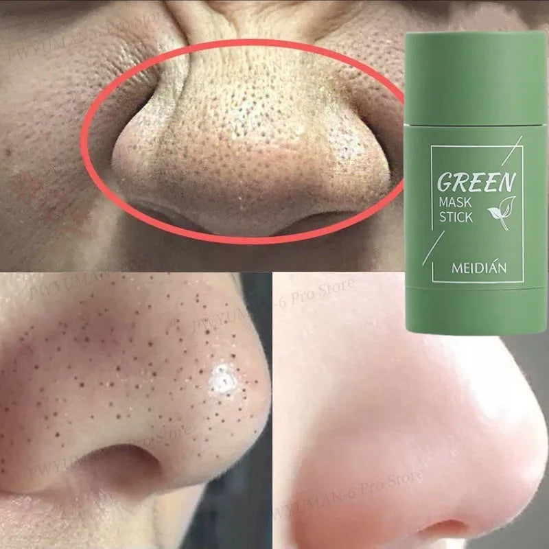 Green Skin Care - a Solução para Acne e Cravos